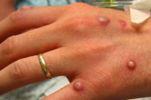 إسبانيا تسجل أول حالة وفاة بمرض جذري&hellip;